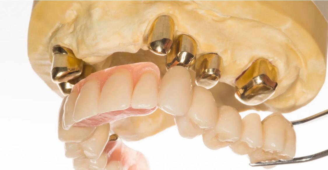 Herausnehmbarer Zahnersatz